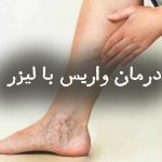 درمان واریس با لیزر