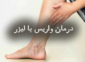 درمان واریس با لیزر