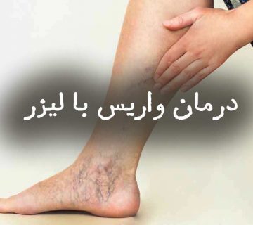درمان واریس با لیزر