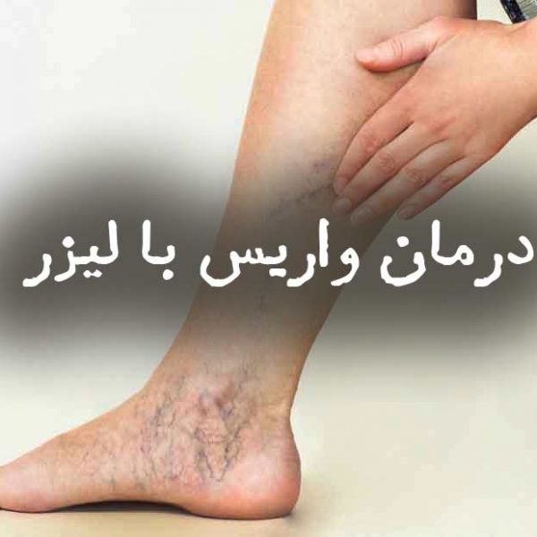 درمان واریس با لیزر